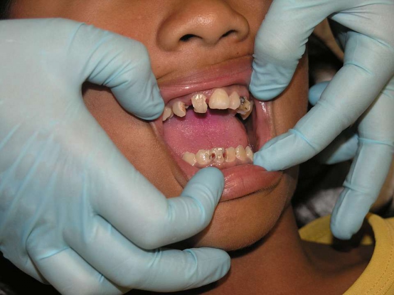 洗牙后牙龈萎缩怎么办为什么洗牙之后牙龈萎缩